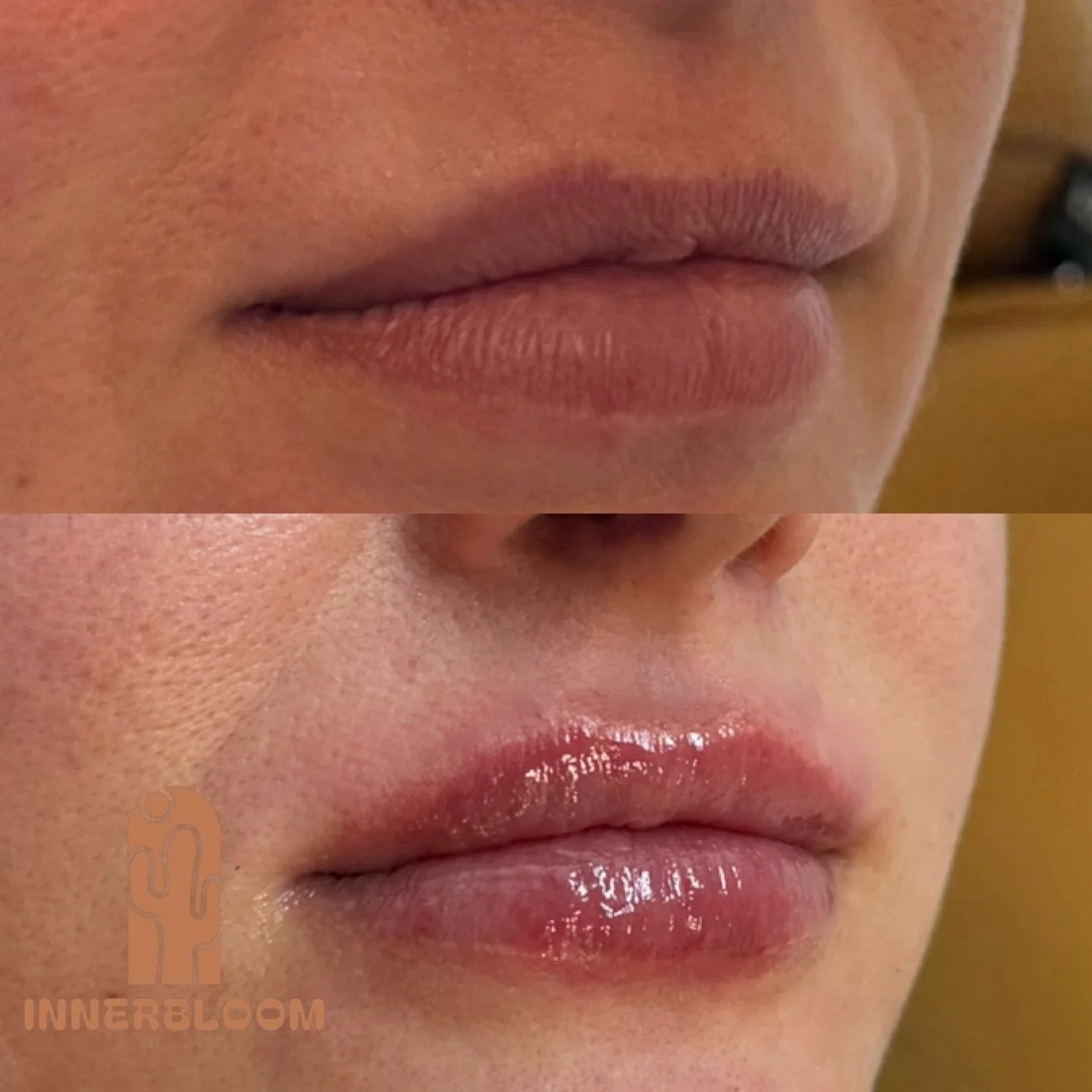 Let&rsquo;s Talk About the Necessary Step Nobody Wants: ⚡️DISSOLVING⚡️

This transformation started with a full lip dissolve to address prior filler migration and heaviness, specifically noticeable on the patient&rsquo;s left upper lip. After allowin