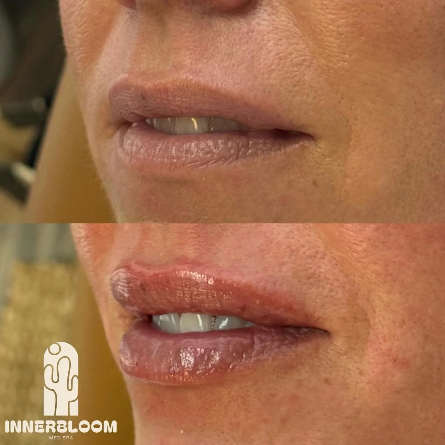 🔊 Don&rsquo;t mind the neighbors, I&rsquo;m turning up the volume over here!

💉 Half a syringe of @revanesse did wonders for a bit of lower lip volume, and most importantly&hellip;

💧H-Y-D-R-A-T-I-O-N💧

📆 Appointment slots still available in Aug