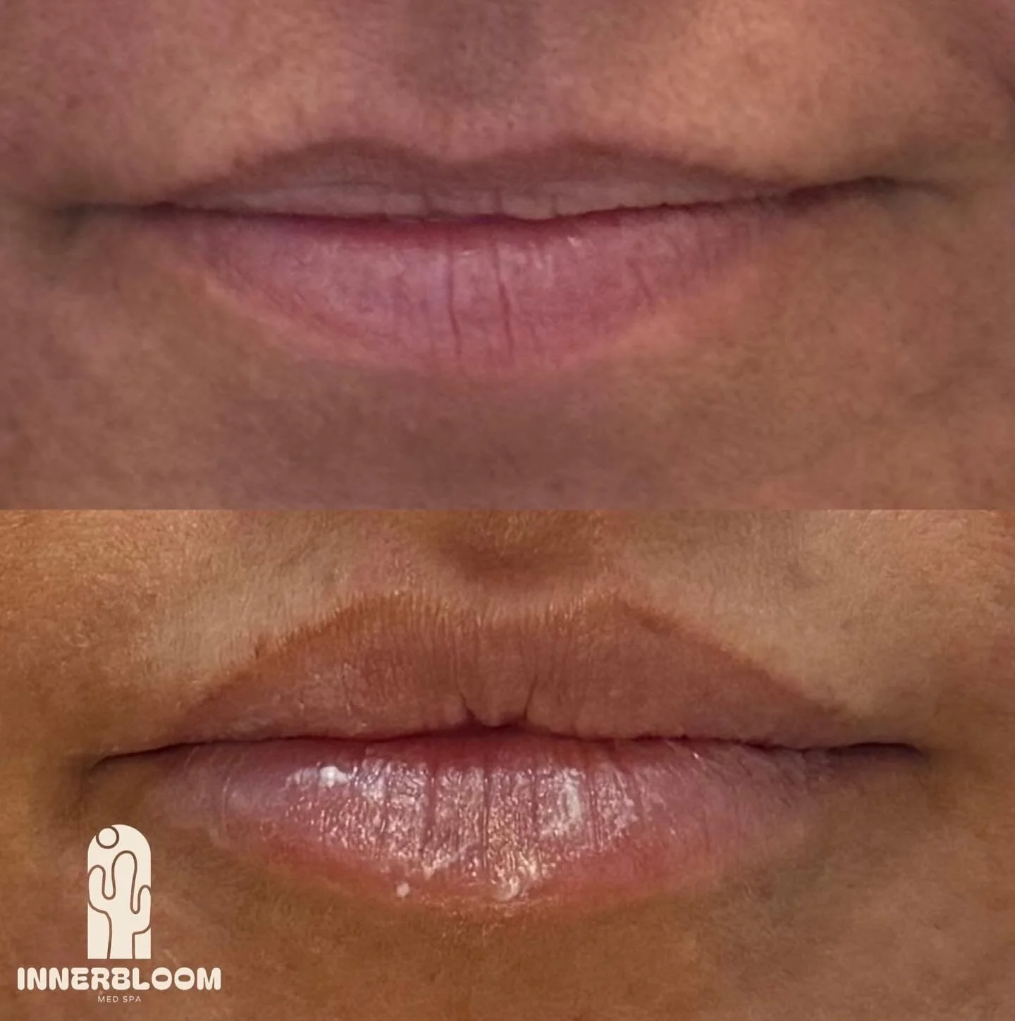 VERITCAL HEIGHT IS IN THE ROOM!!!! 

4 weeks post-treatment, these lips are 🧨! Patient already has such beautiful shape so we wanted to preserve those but just give them a bit of ✨oomph✨

I used 1.2ml of @revanesse Versa Lips to add a little vertica