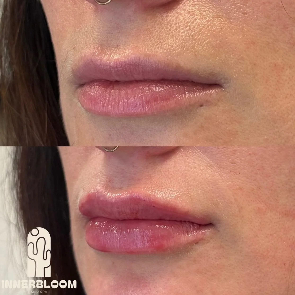 🌵 A subtle change that&rsquo;s new, but still keeps you, you. We&rsquo;re all about highlighting your natural beauty, not overshadowing it. 

📆 Book a free consultation today - we&rsquo;ll chat about ways dermal filler can provide just the amount o