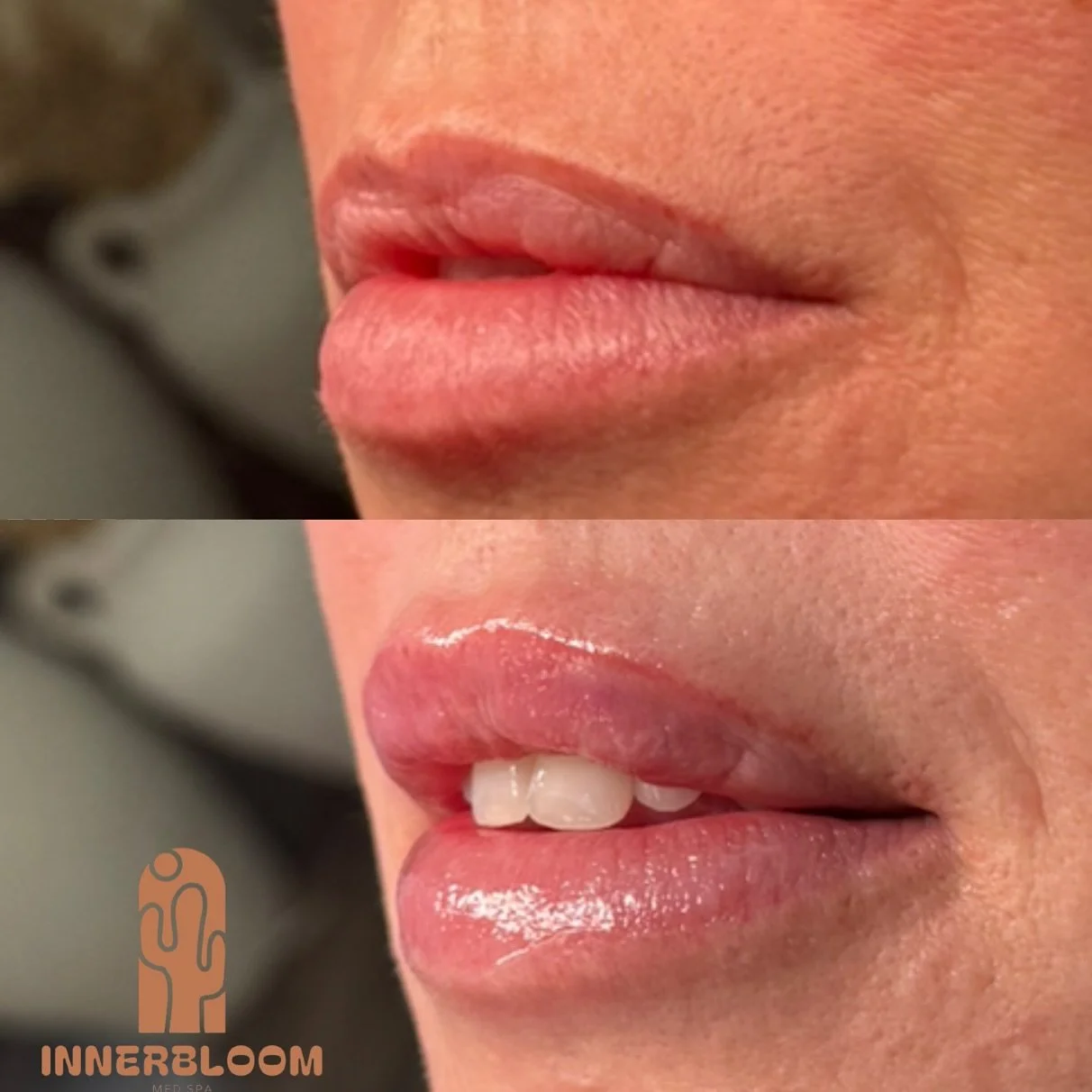 SUBTLETY is the name of the game. 

Lips don&rsquo;t have to be overdone to make an impact; sometimes the most beautiful results are the ones that simply enhance what&rsquo;s already there. 

#filler #lipfiller #littleton #revanesselips #revanesse #c