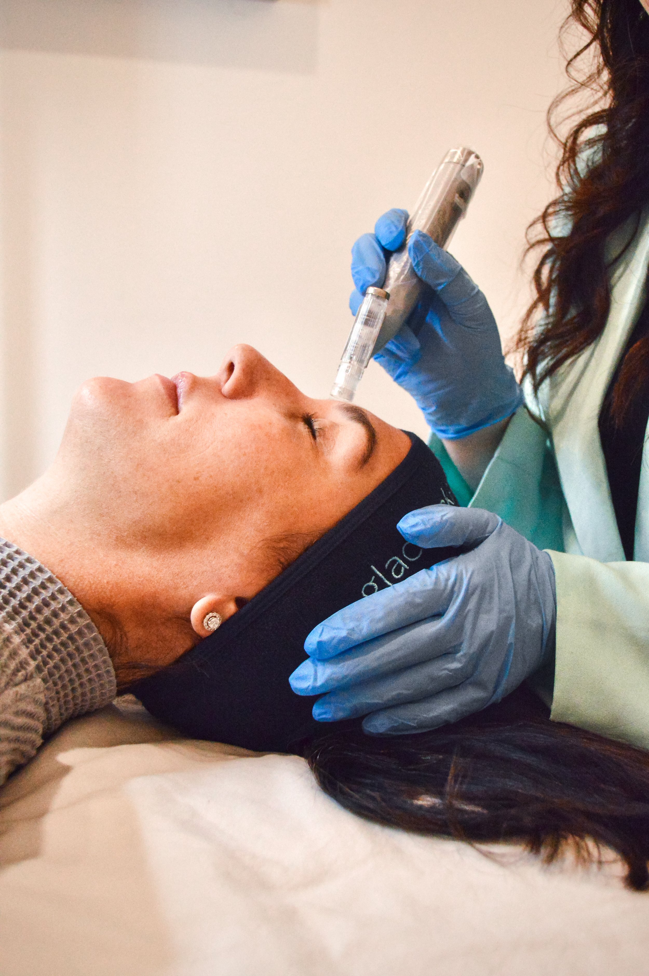 Microneedling in Birmingham, Alabama