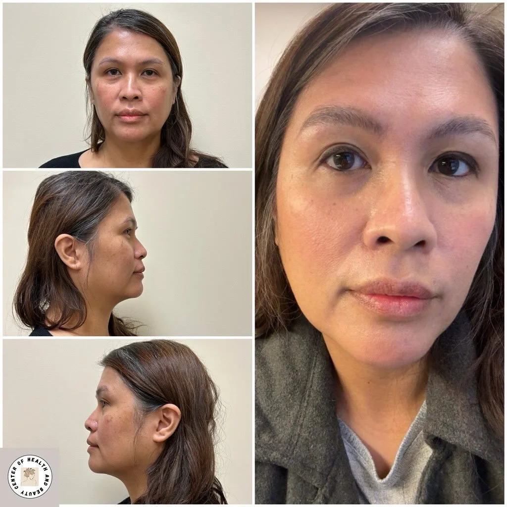 Before and after , 1 Potenza treatment.