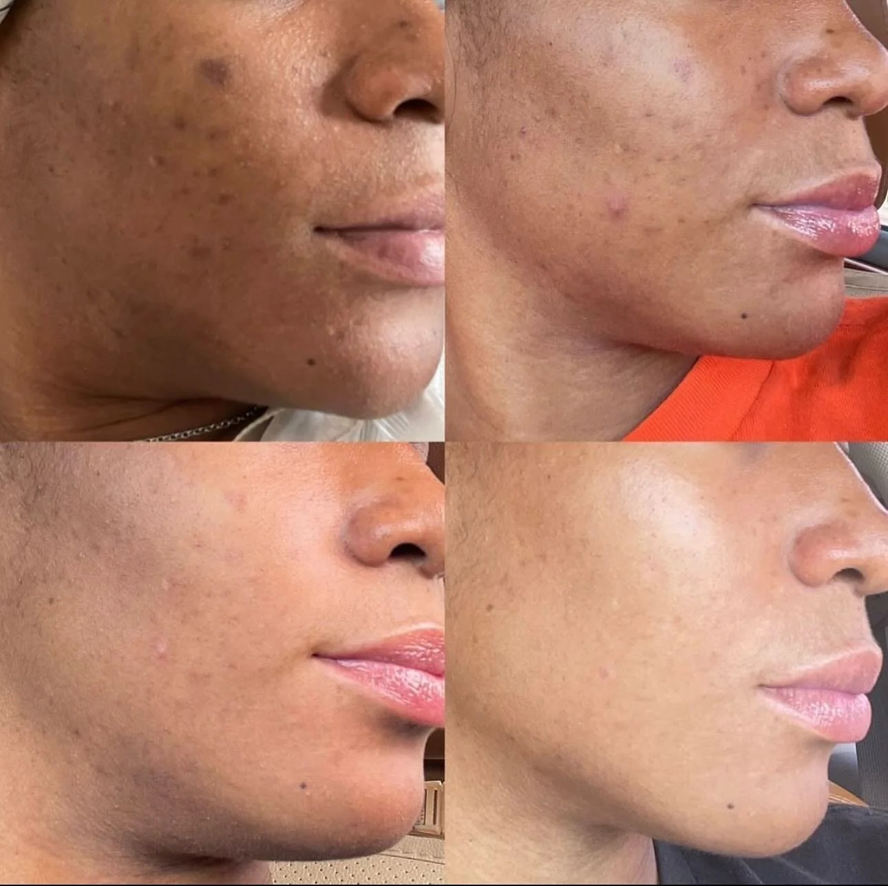 Here&rsquo;s some things you should know! ⁣
⁣
🔑 One chemical peel isn&rsquo;t enough!!! ⁣
⁣
🔑Hormonal acne takes time and consistency!! ⁣
⁣
🔑Pimples patches don&rsquo;t work on cystic acne!! ⁣
⁣
🔑If you&rsquo;re not peeling that doesn&rsquo;t mea