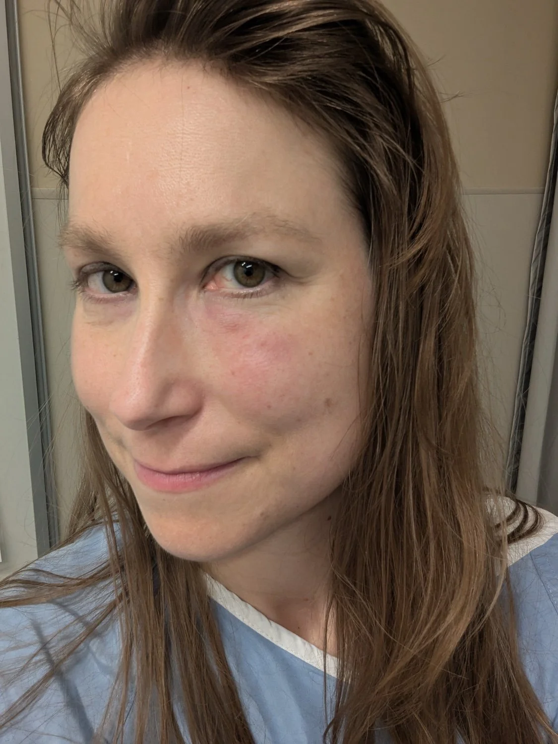 The be-hospital-gowned author's face with bruising under one eye from a blood product injection.