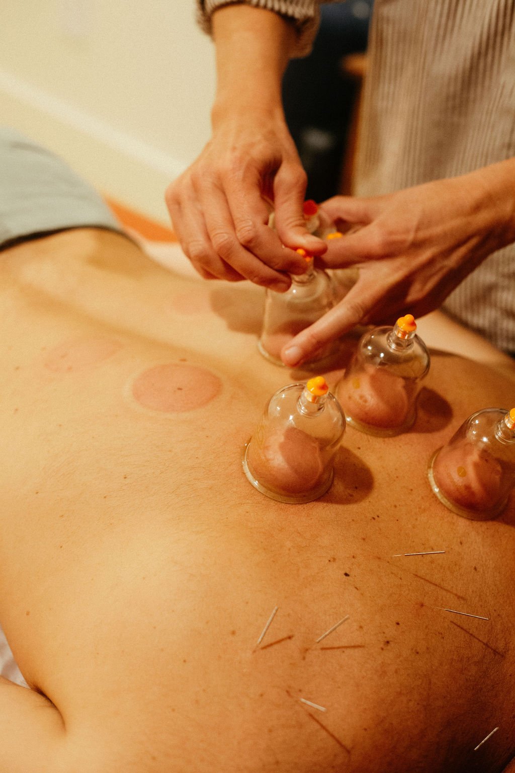Cupping for stress and pain at our Portland, Maine clinic.