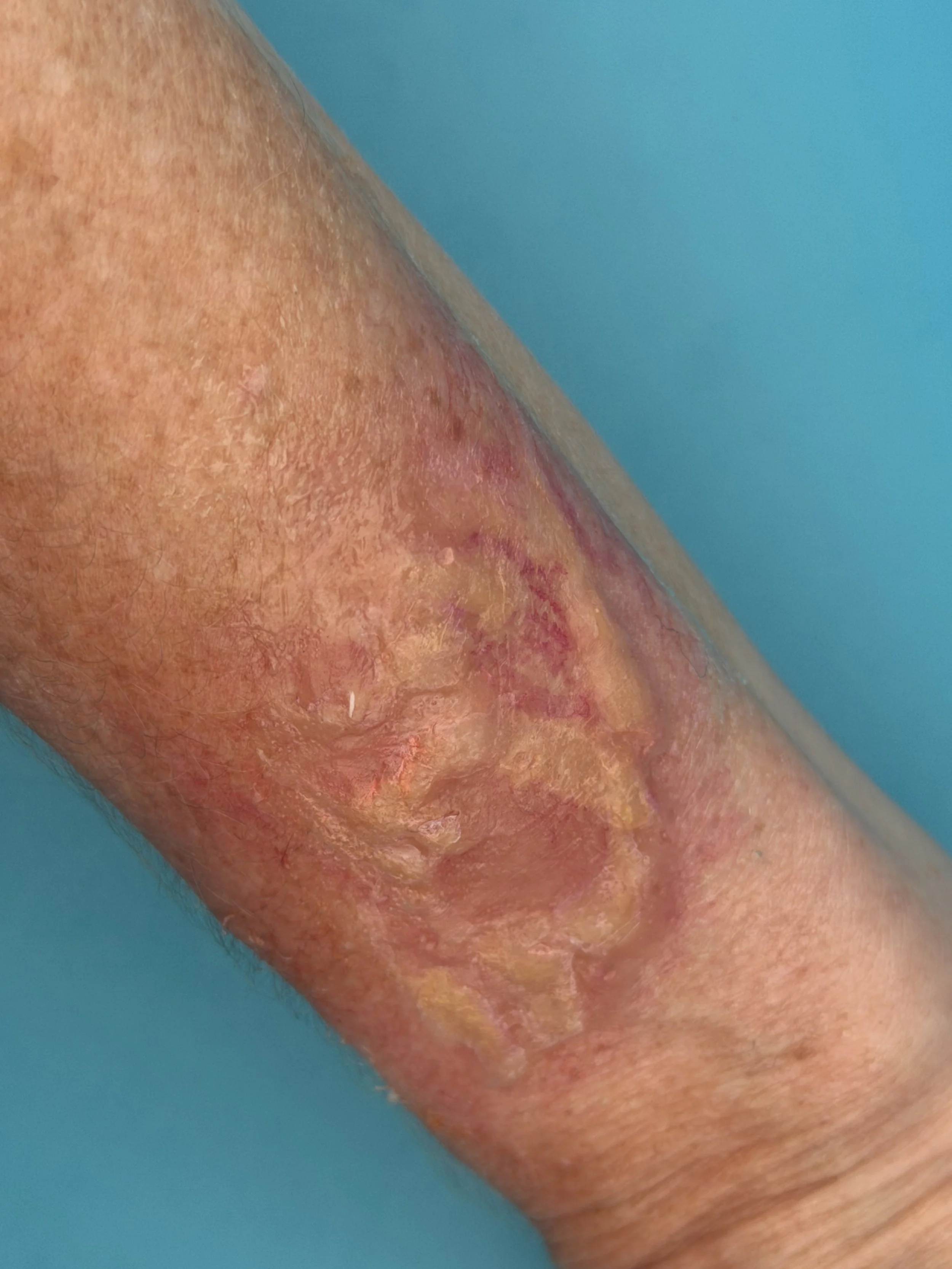 Skin Infection Series- Raised Infection