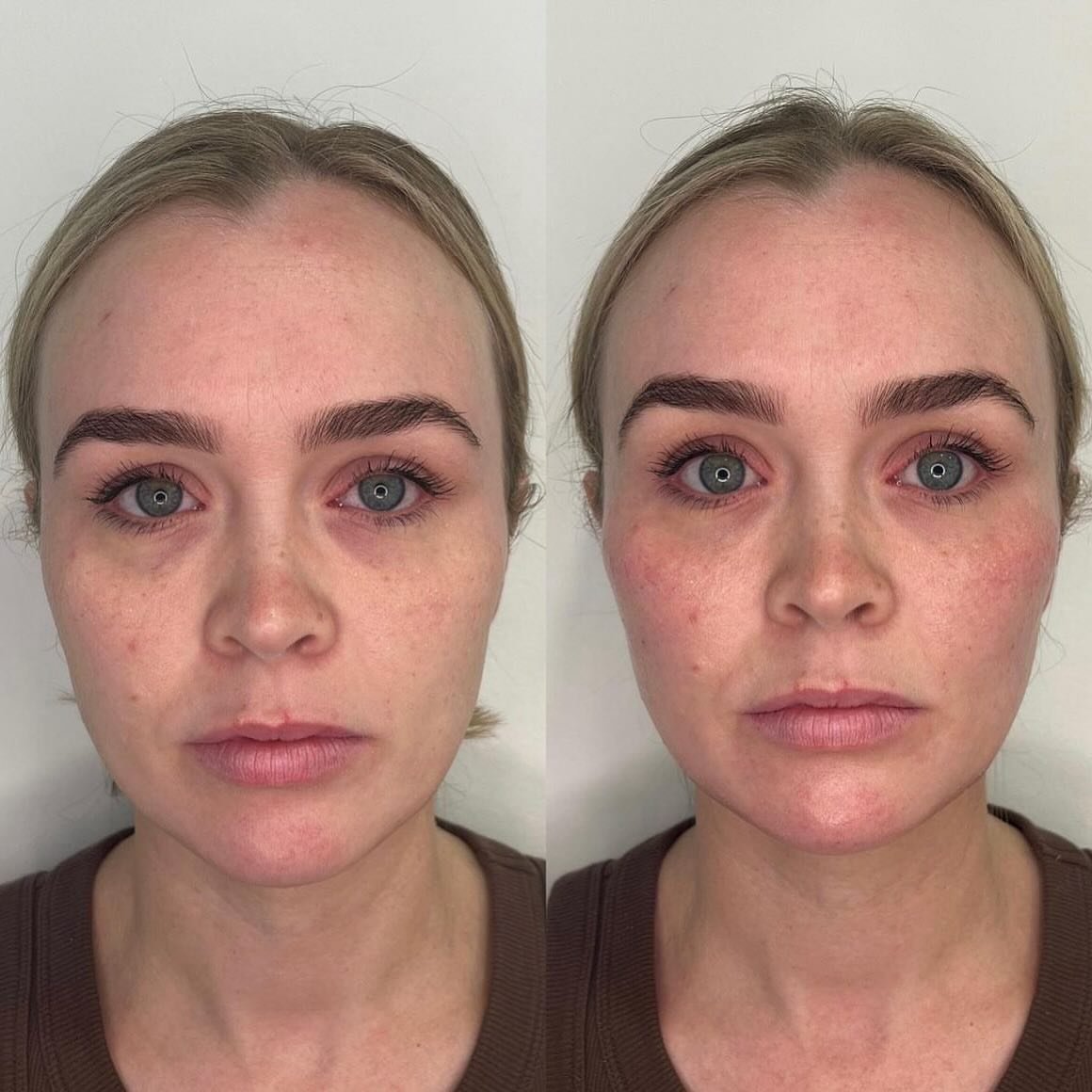 Facial rejuvenation using a multimodality approach. 

For more information on how you can achieve these results, please book in for a consultation via booking link. Consultations are key to developing a customised treatment plan.