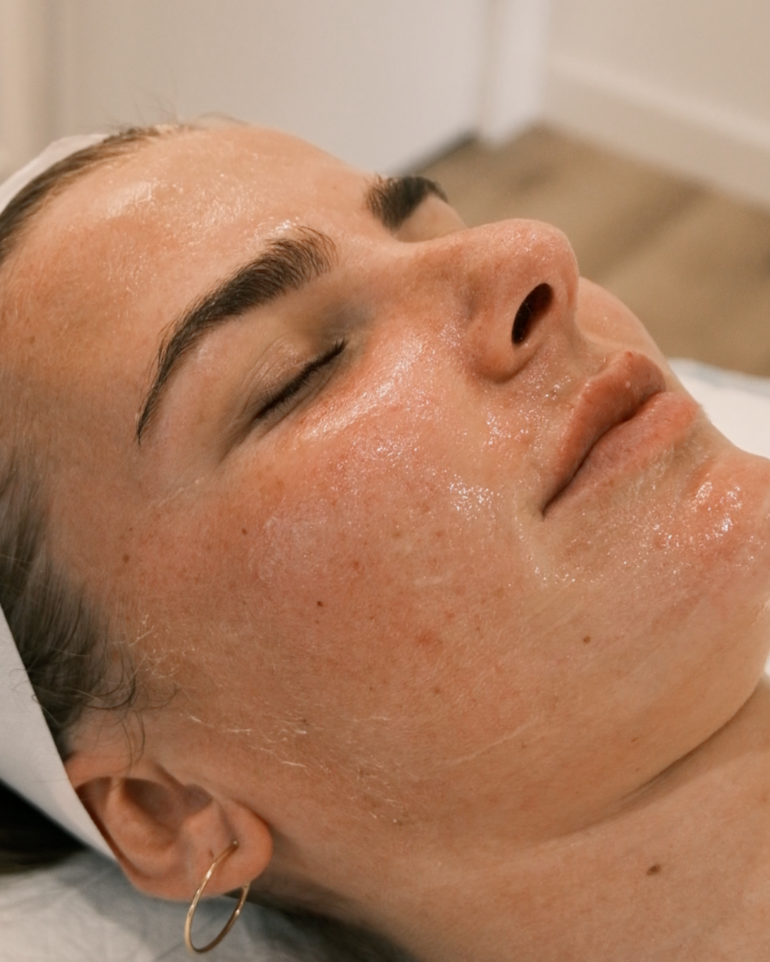Chemical Peels