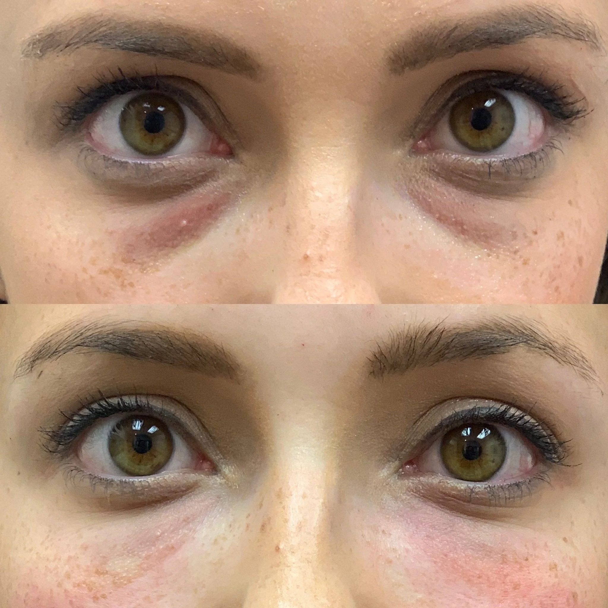 Before and after photos of prf and bright eyes treatment to stimulate natural collagen and skin rejuvenation.