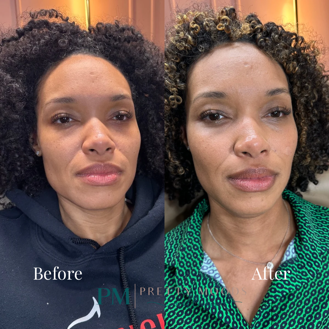 Sculptra -Top Tier Medspa in Altamonte Springs, FL 32714