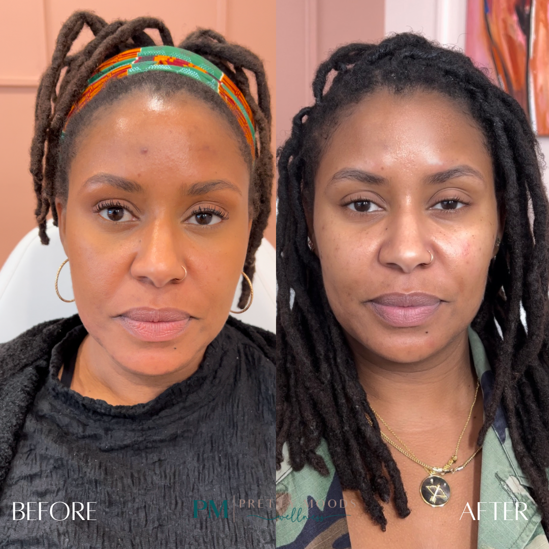 Full Facial Balance -Top Tier Medspa in Altamonte Springs, FL 32714