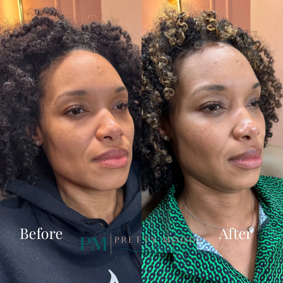 Sculptra -Top Tier Medspa in Altamonte Springs, FL 32714