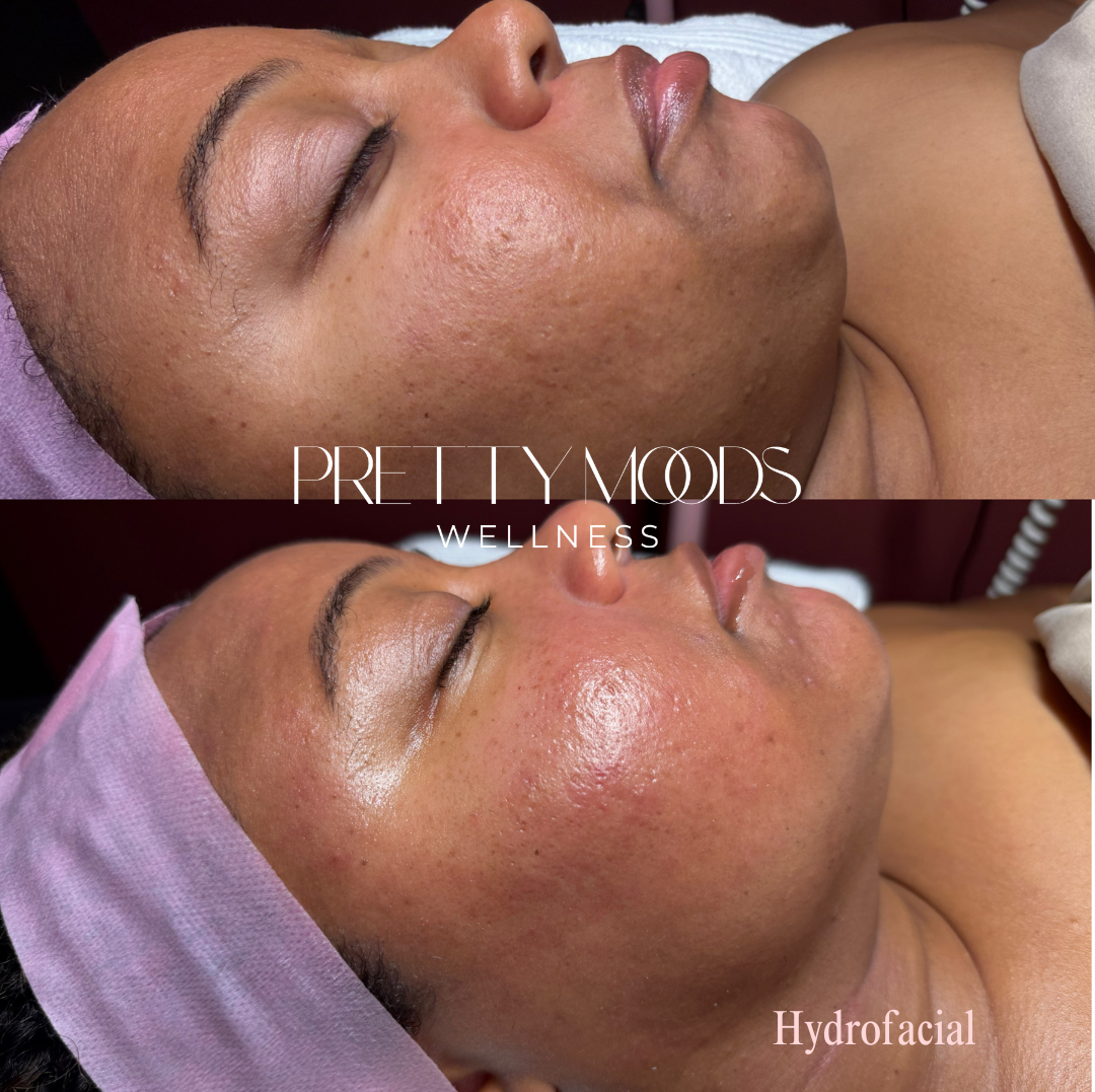 Deep Pore Facial -Top Tier Medspa in Altamonte Springs, FL 32714