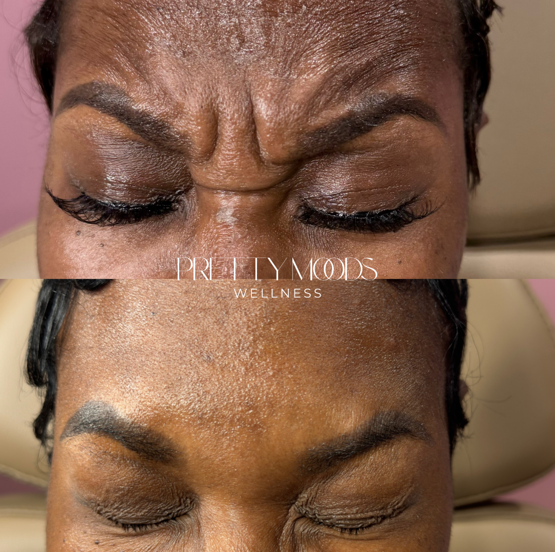 Wrinkle Relaxer Treatment -Top Tier Medspa in Altamonte Springs, FL 32714