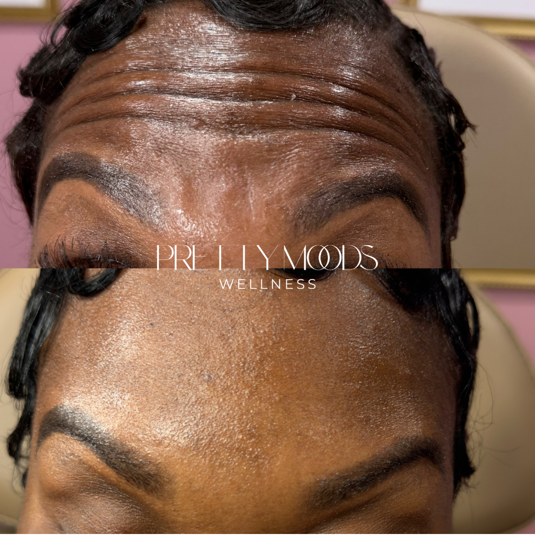 Wrinkle Relaxer Treatment -Top Tier Medspa in Altamonte Springs, FL 32714