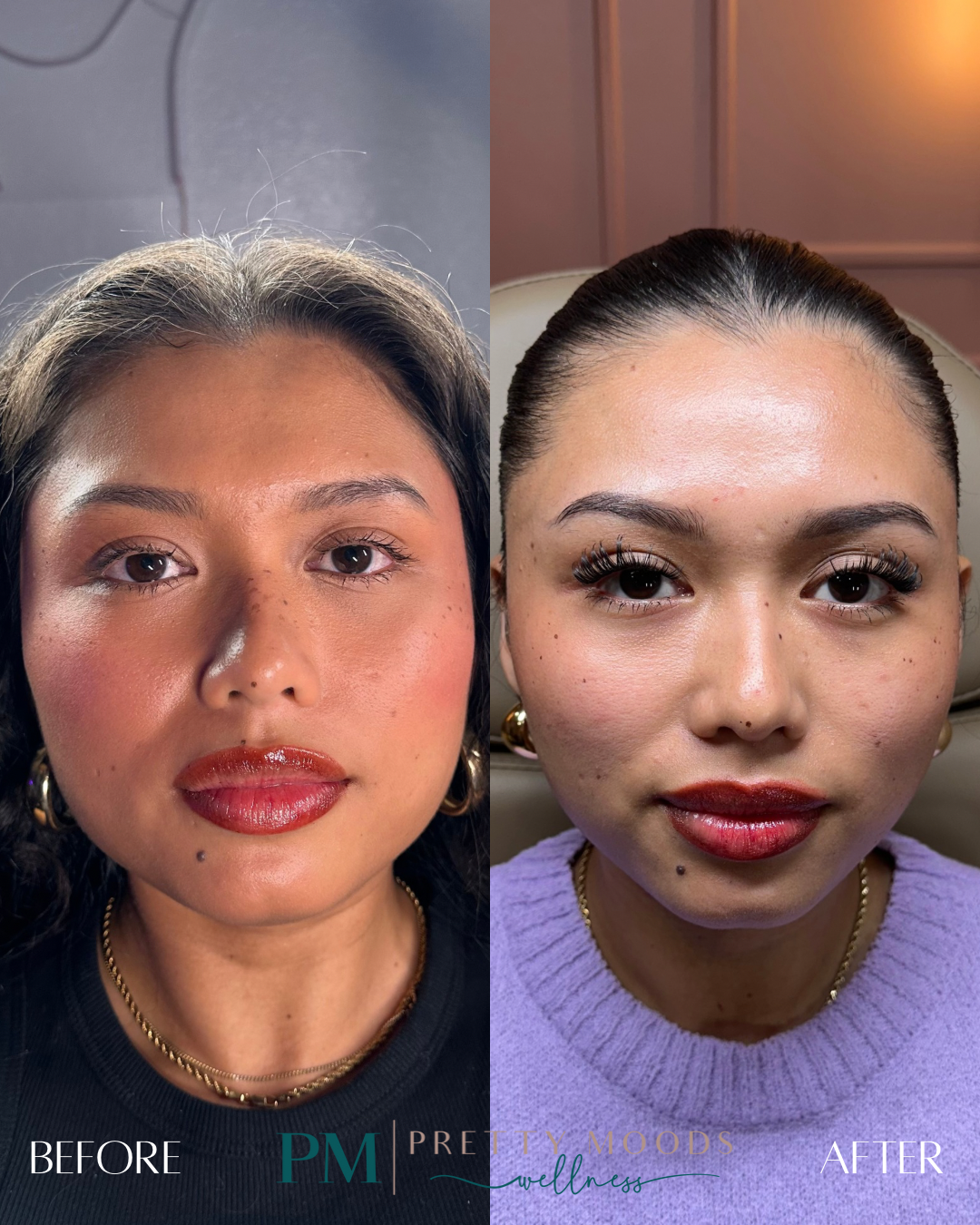 Masseter Botox -Top Tier Medspa in Altamonte Springs, FL 32714