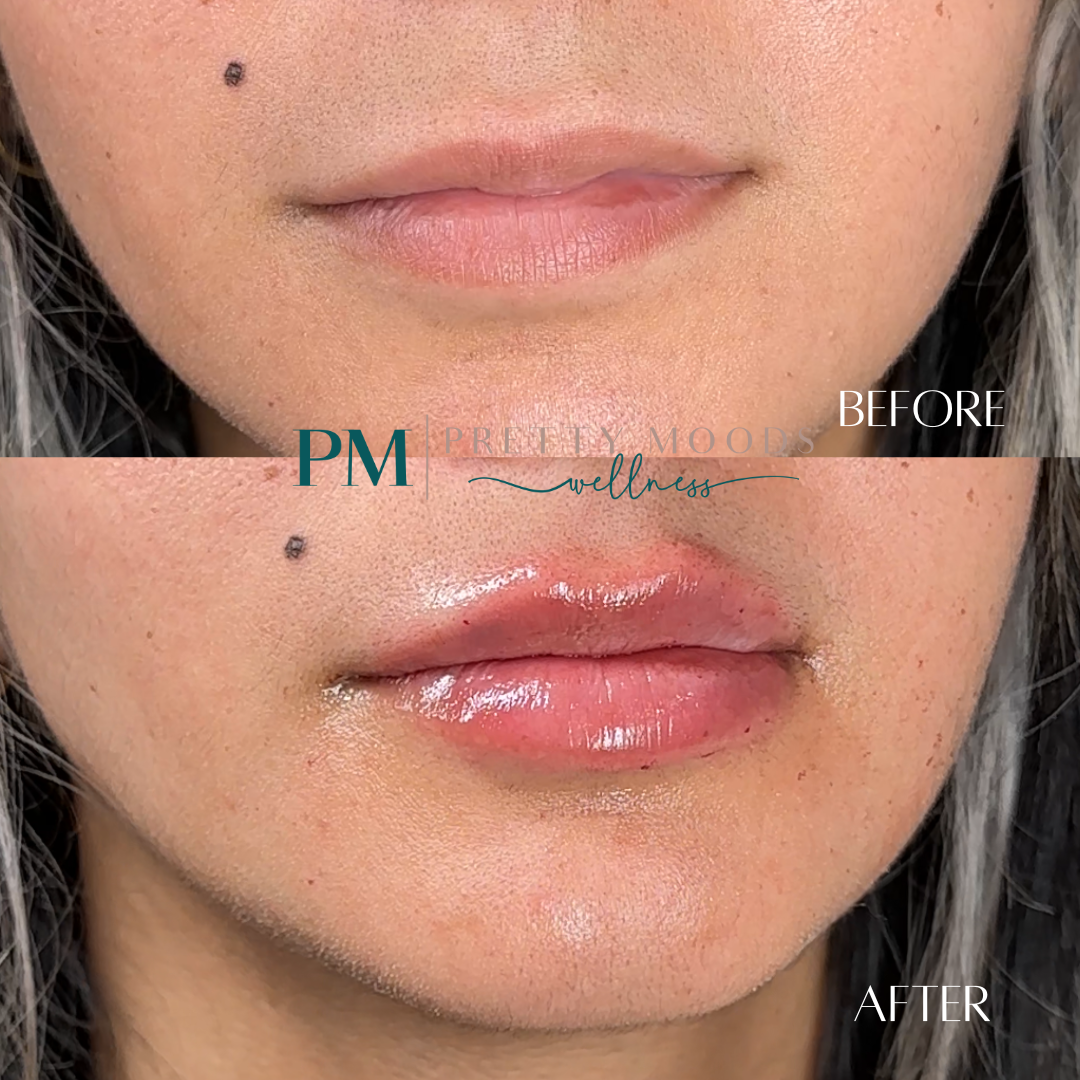 Lip Filler -Top Tier Medspa in Altamonte Springs, FL 32714