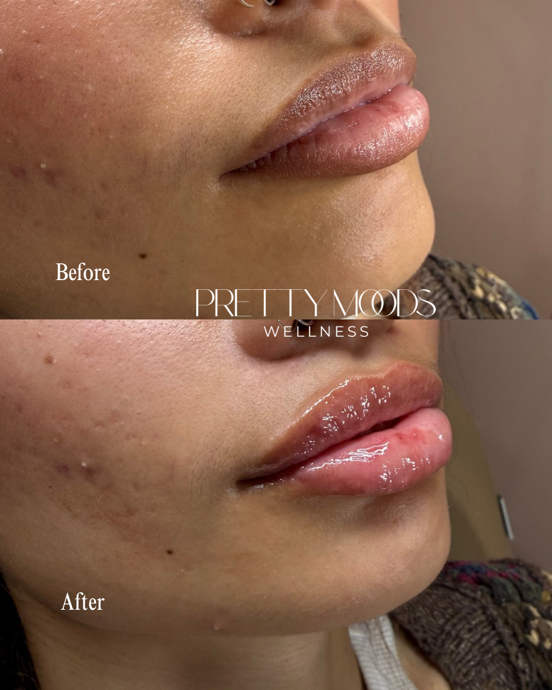 Lip Filler -Top Tier Medspa in Altamonte Springs, FL 32714