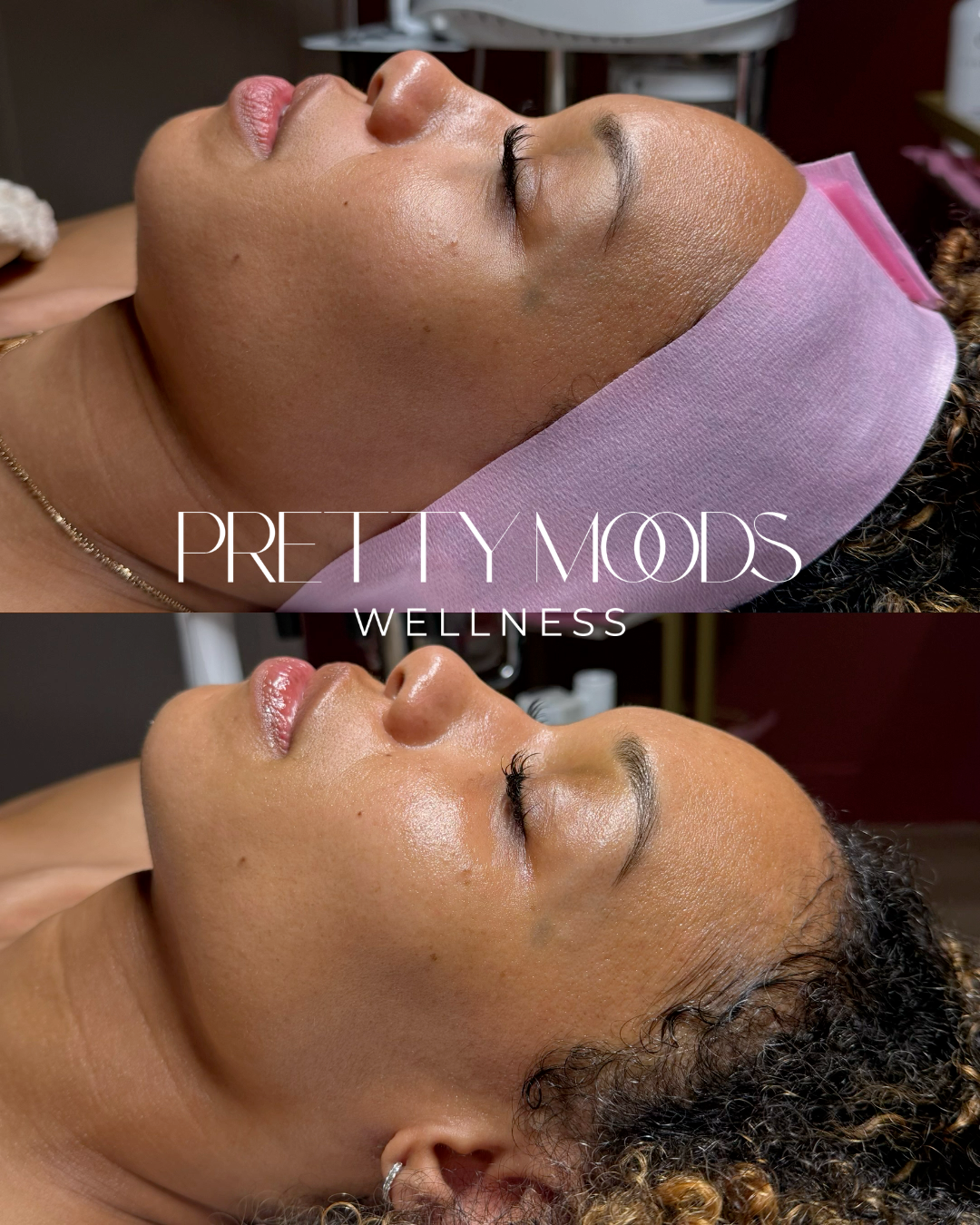 Sculpted Facial-Top Tier Medspa in Altamonte Springs, FL 32714