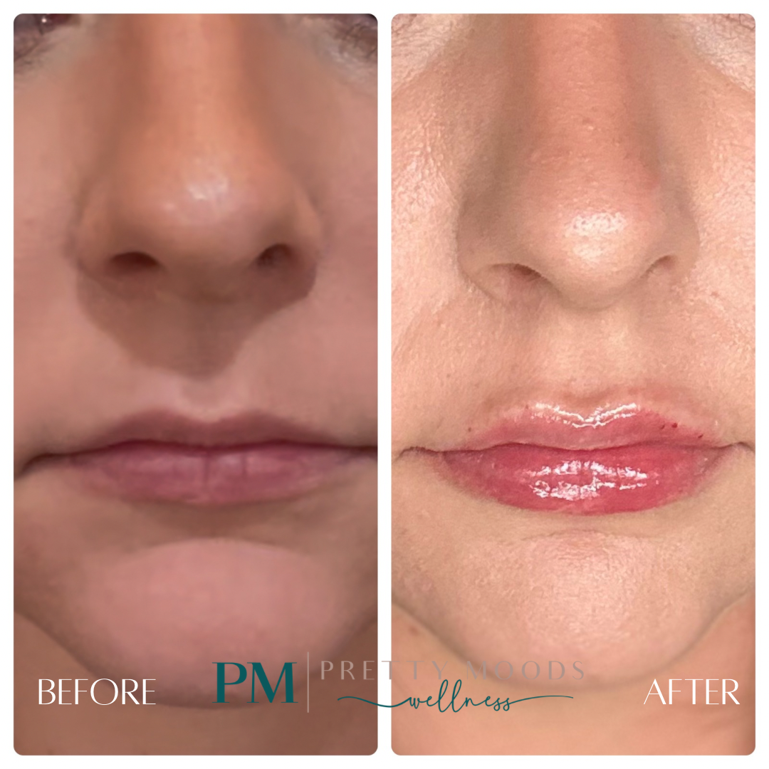 Lip Filler -Top Tier Medspa in Altamonte Springs, FL 32714