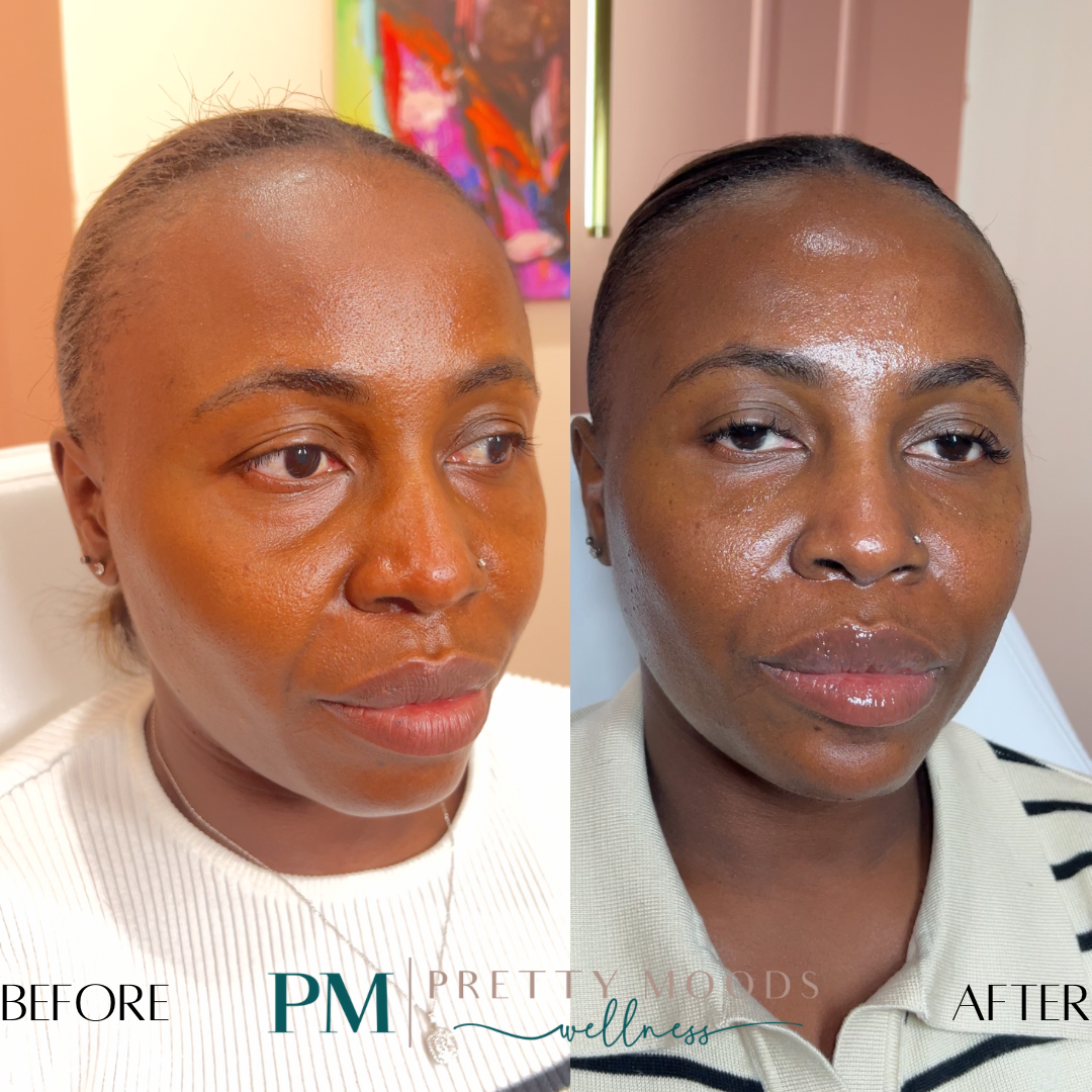 Full Facial Balance -Top Tier Medspa in Altamonte Springs, FL 32714
