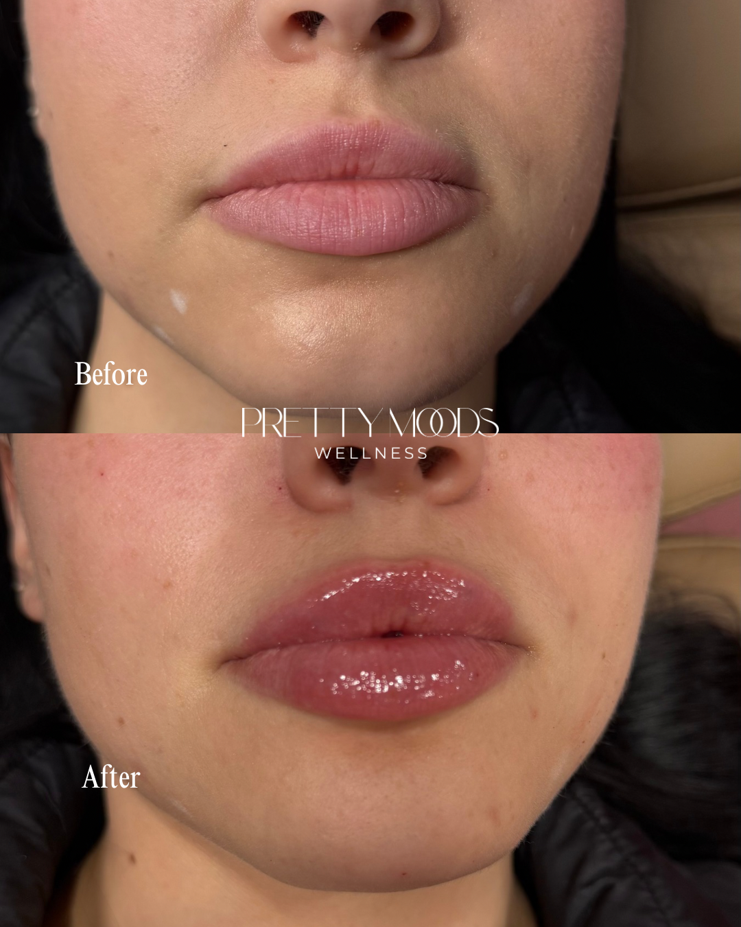 Lip Filler -Top Tier Medspa in Altamonte Springs, FL 32714