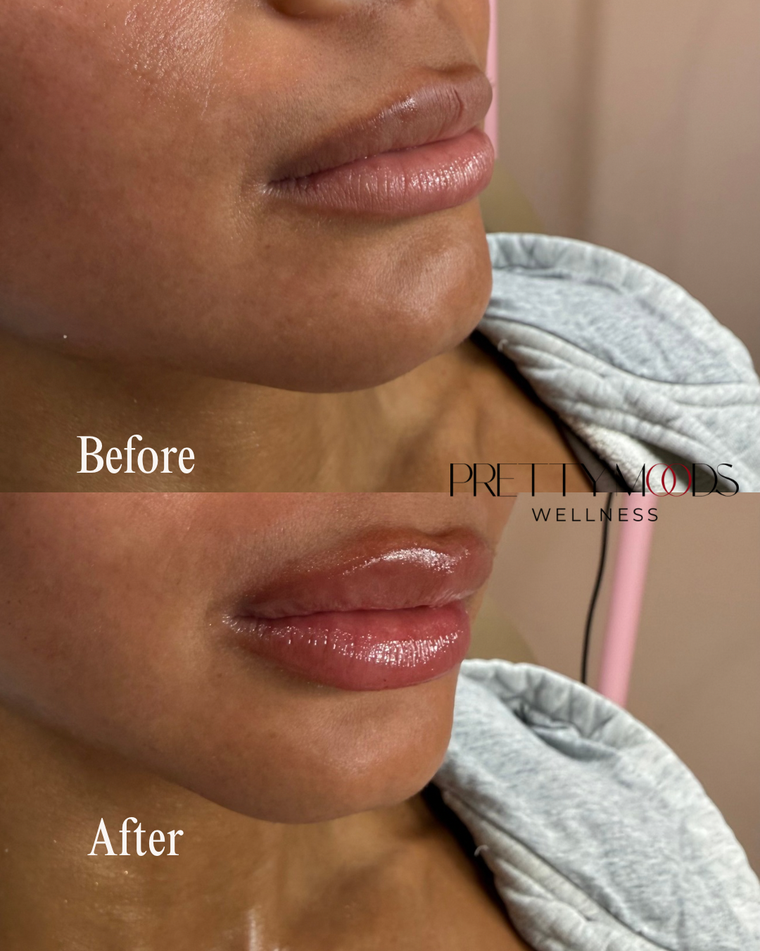 Lip Filler -Top Tier Medspa in Altamonte Springs, FL 32714