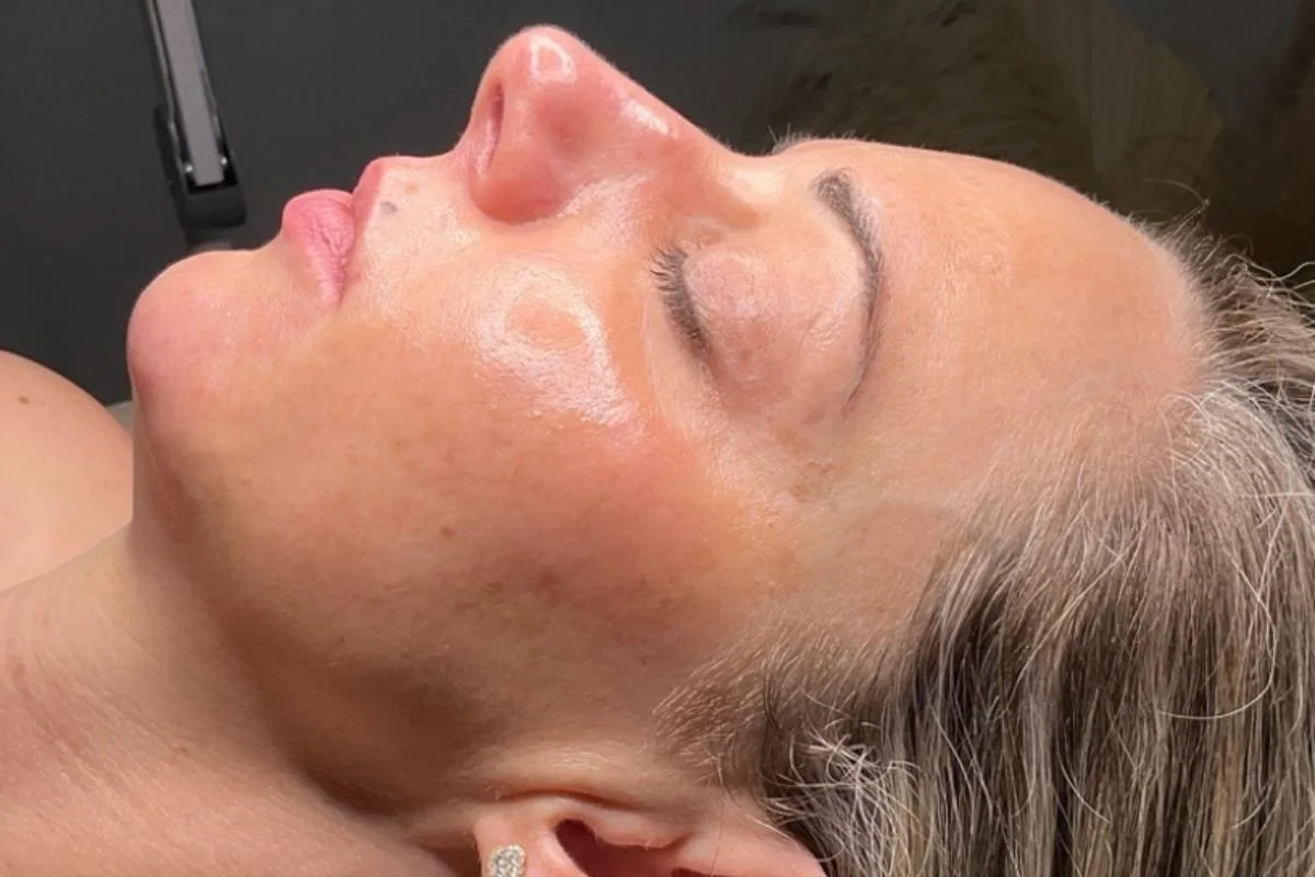 results of a woman getting a chemical peel