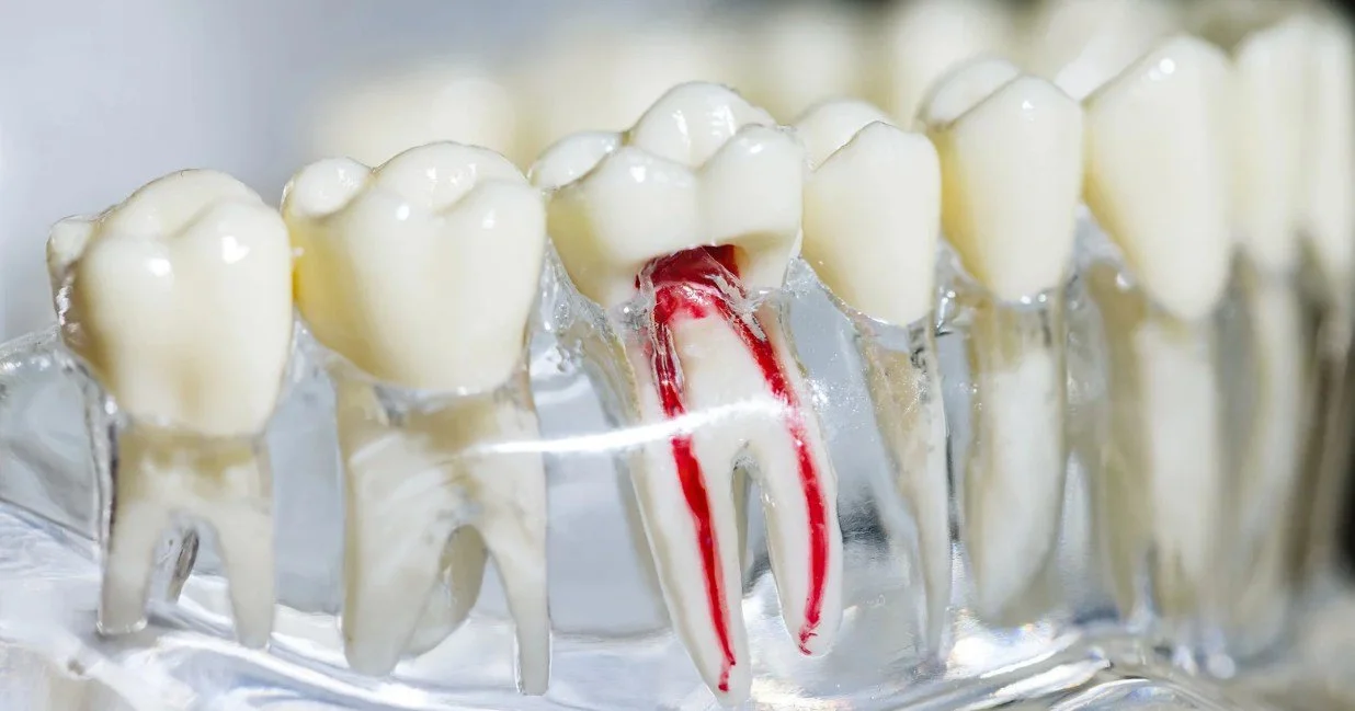 Root Canal Basics: What Happens Inside the Tooth?