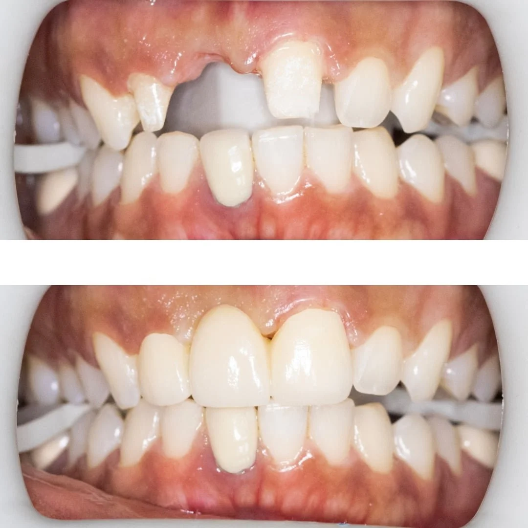 Replacing Missing Front Tooth