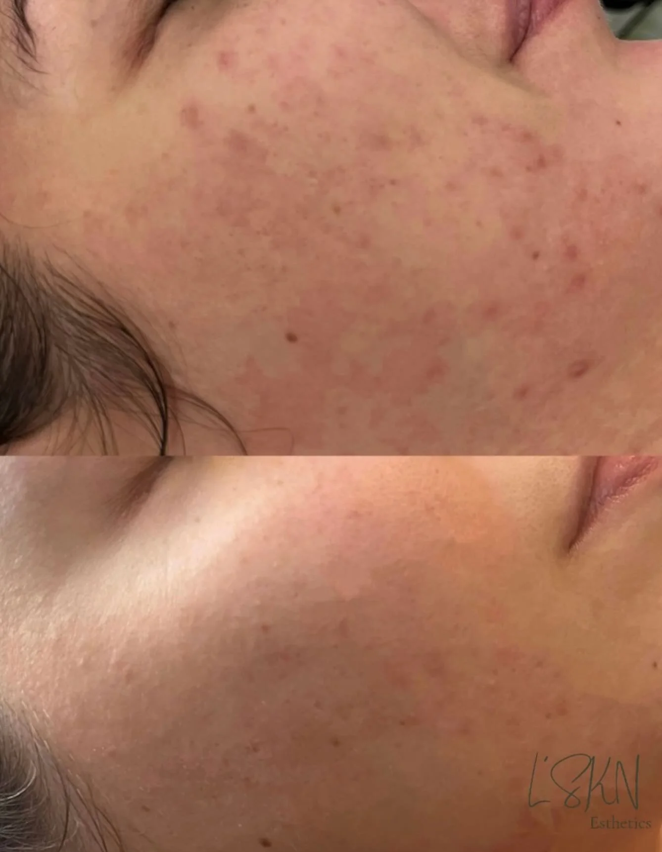 &ldquo;Why does my skin breakout after wearing makeup? Sometimes I get a rash and other times I just breakout really bad.&rdquo;

🤔 Here&rsquo;s why it might be happening: 👇

1️⃣ Clogged Pores: Heavy foundation or powder can trap oil, dirt, and swe