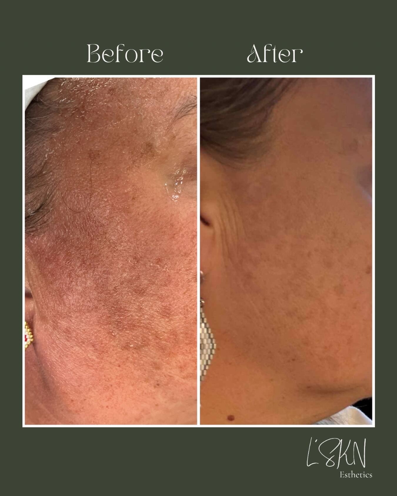✨Chemical Peel Results: 1 Session ✨

This client came in with concerns of pigmentation, and after just one session, we&rsquo;ve already achieved visible brightening and a more even skin tone.

She&rsquo;s now continuing her journey with a series of m