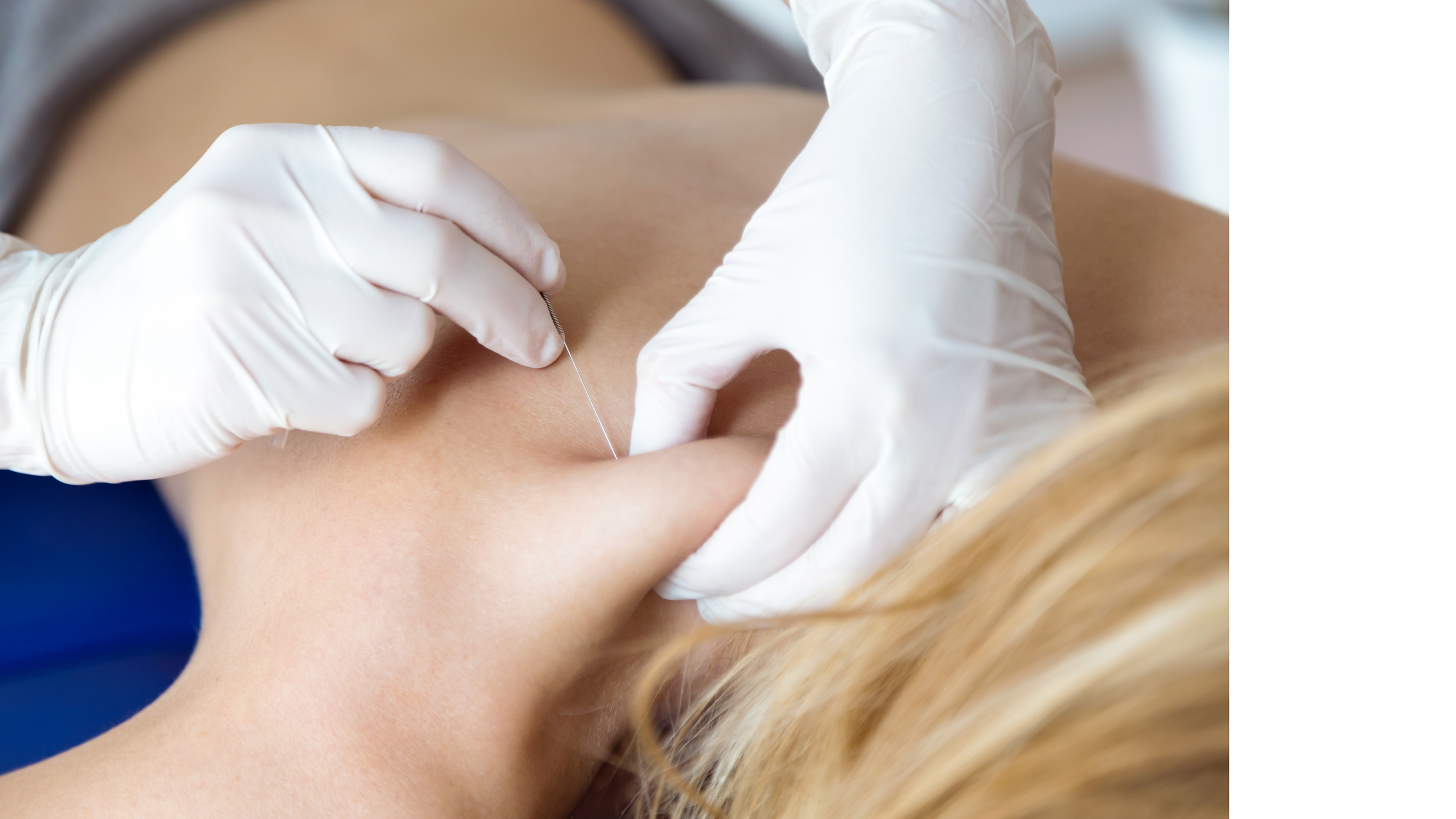 Dry Needling Is Acupuncture: Why Language, Training, and Scope Matter