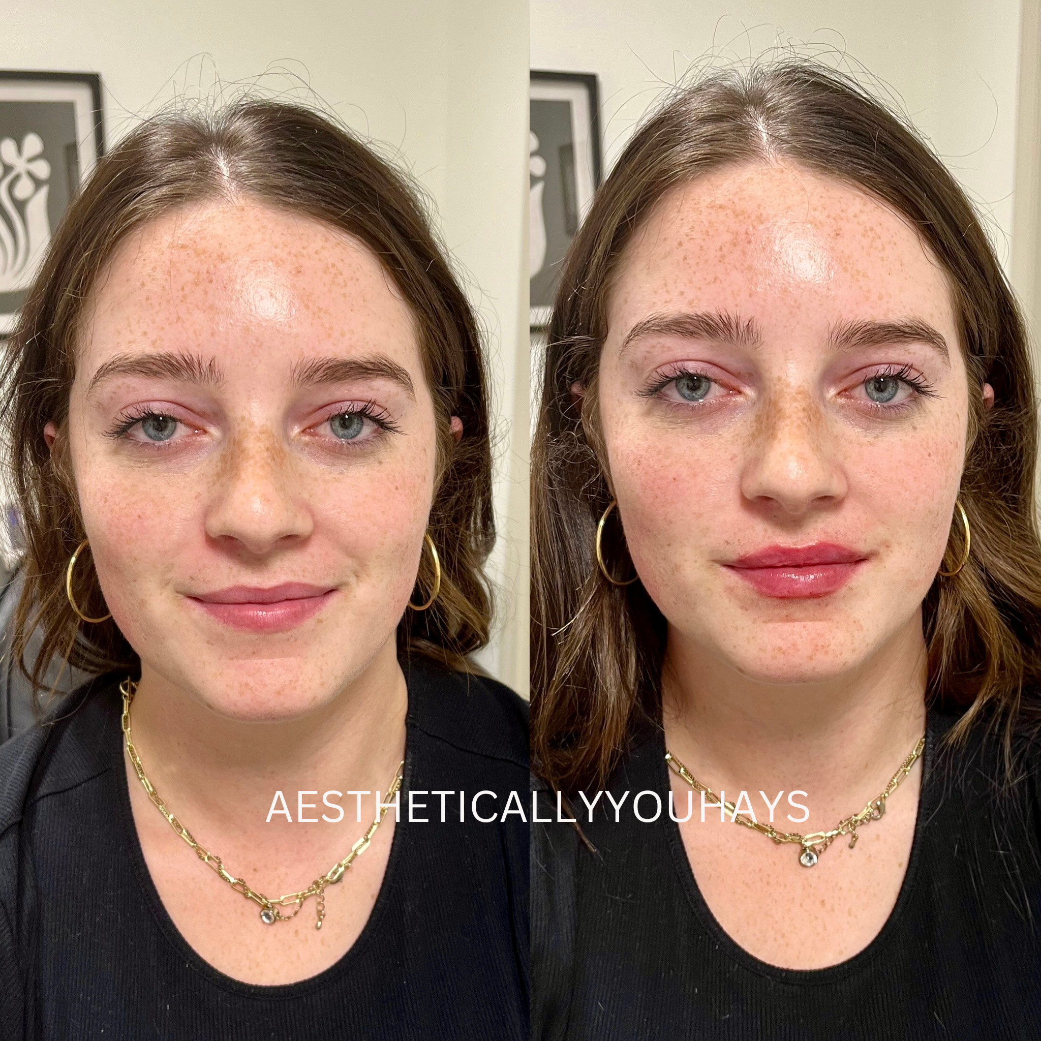 Lip Filler 1/2 Syringe