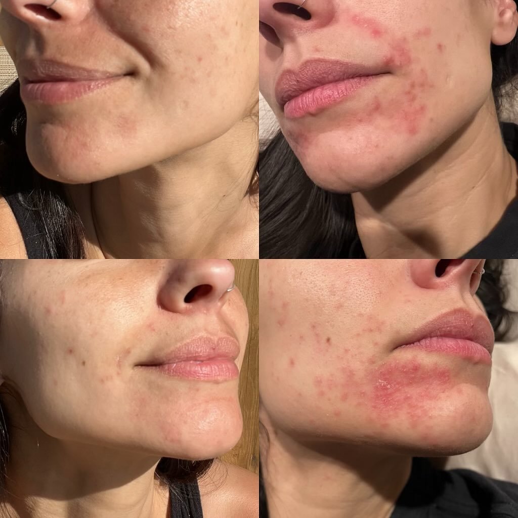 Clearing skin from within. 

What&rsquo;s the point of great skin care if you aren&rsquo;t taking care of your gut health?

Great skin takes T I M E. 
This has been such a treat to watch this beautiful friend/client of mine find the balance of a gent
