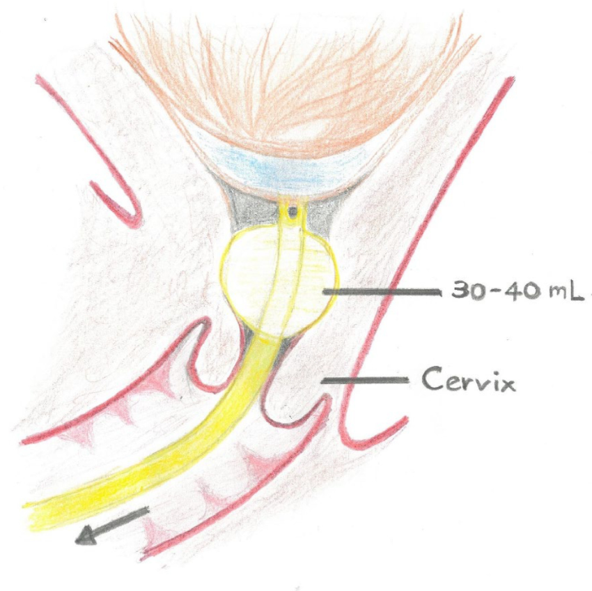 Induction of labor with a small balloon that is inserted. There are different induction methods and you should ask your provider what your options are and/or get with your doula to discuss options prenatally.