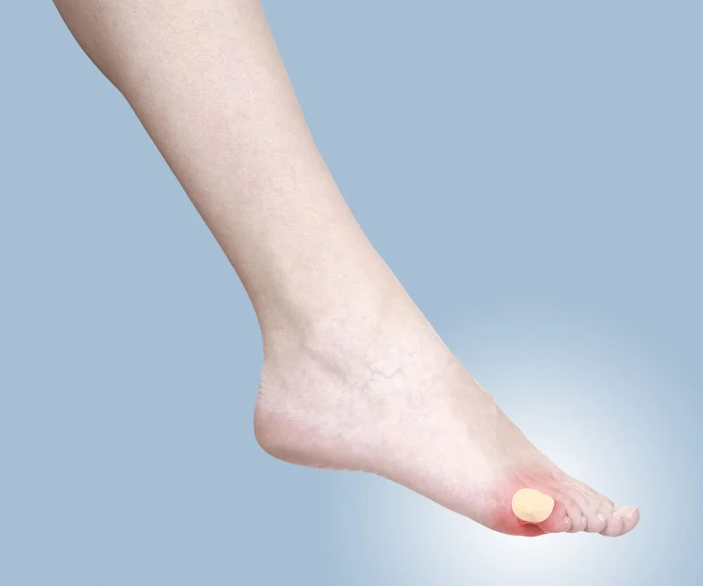 blister treatment brooklyn ny dyker park footcare podiatrist