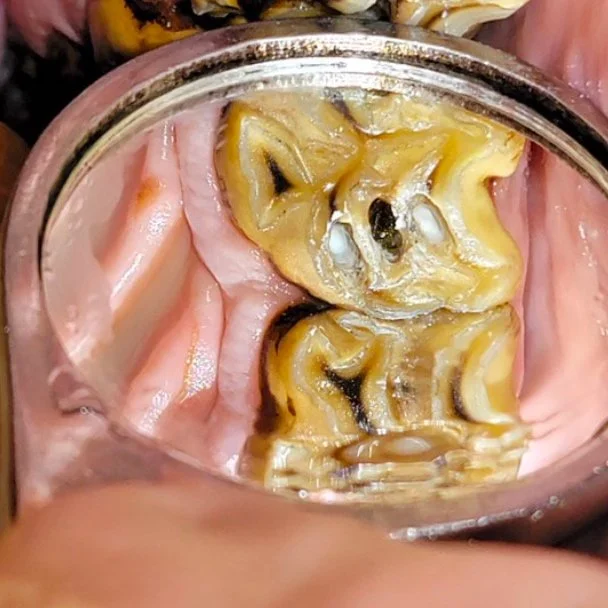 sealant placed in disease pulp horns during endodontic restoration