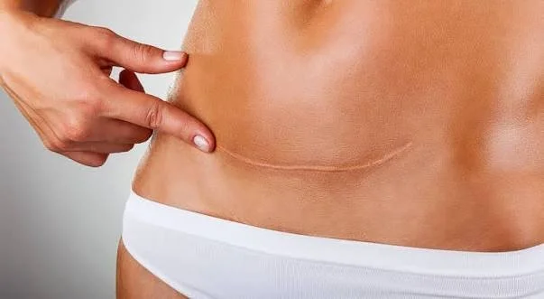 August Blog: Restoring Confidence Through Scar Restoration