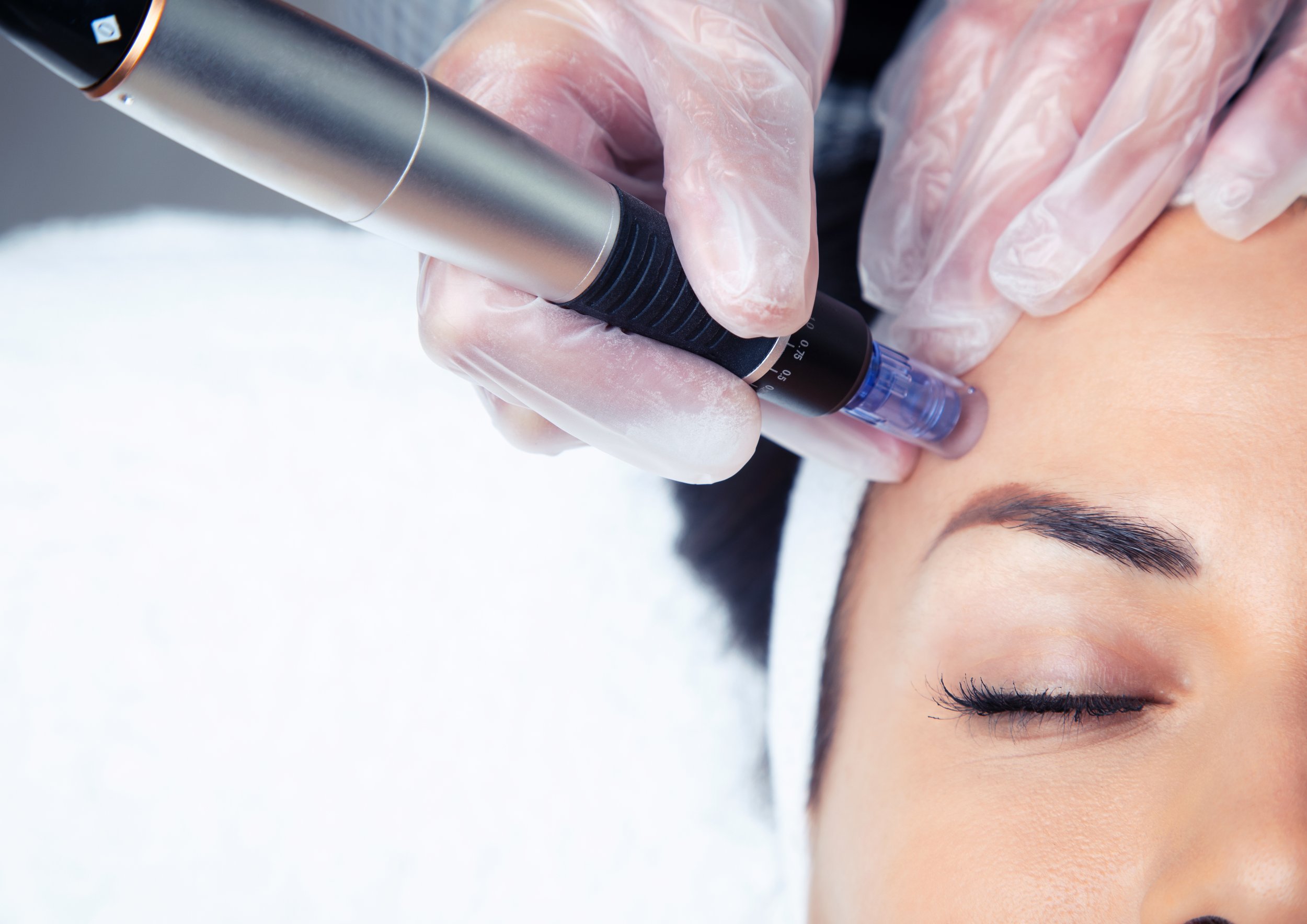The Benefits of Microneedling