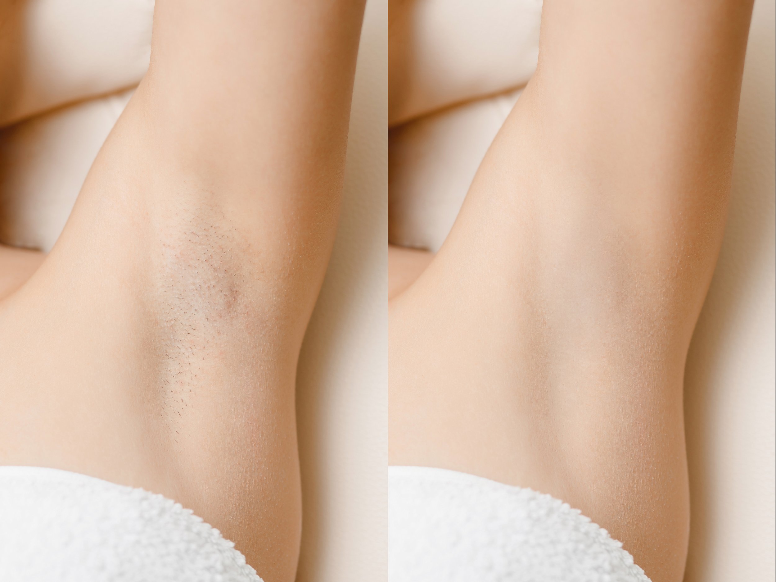 Debunking the Myths of Laser Hair Removal