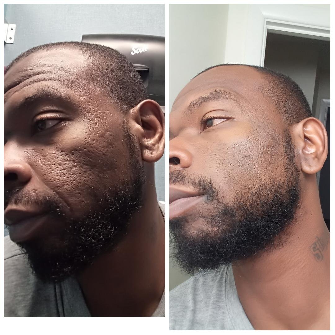 How to Deal with Acne Scarring