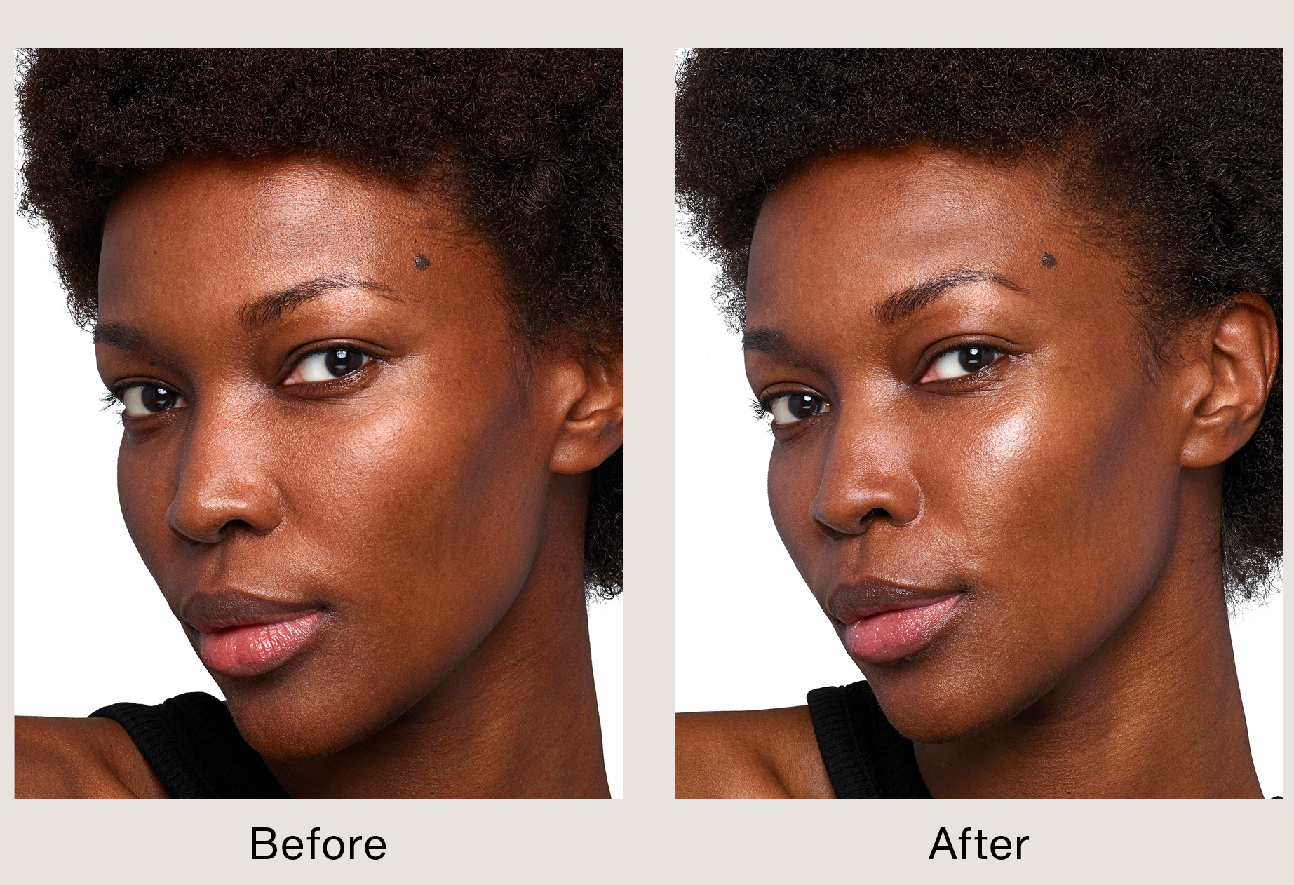 Microneedling vs. RF Microneedling: Which Treatment is Right for You?