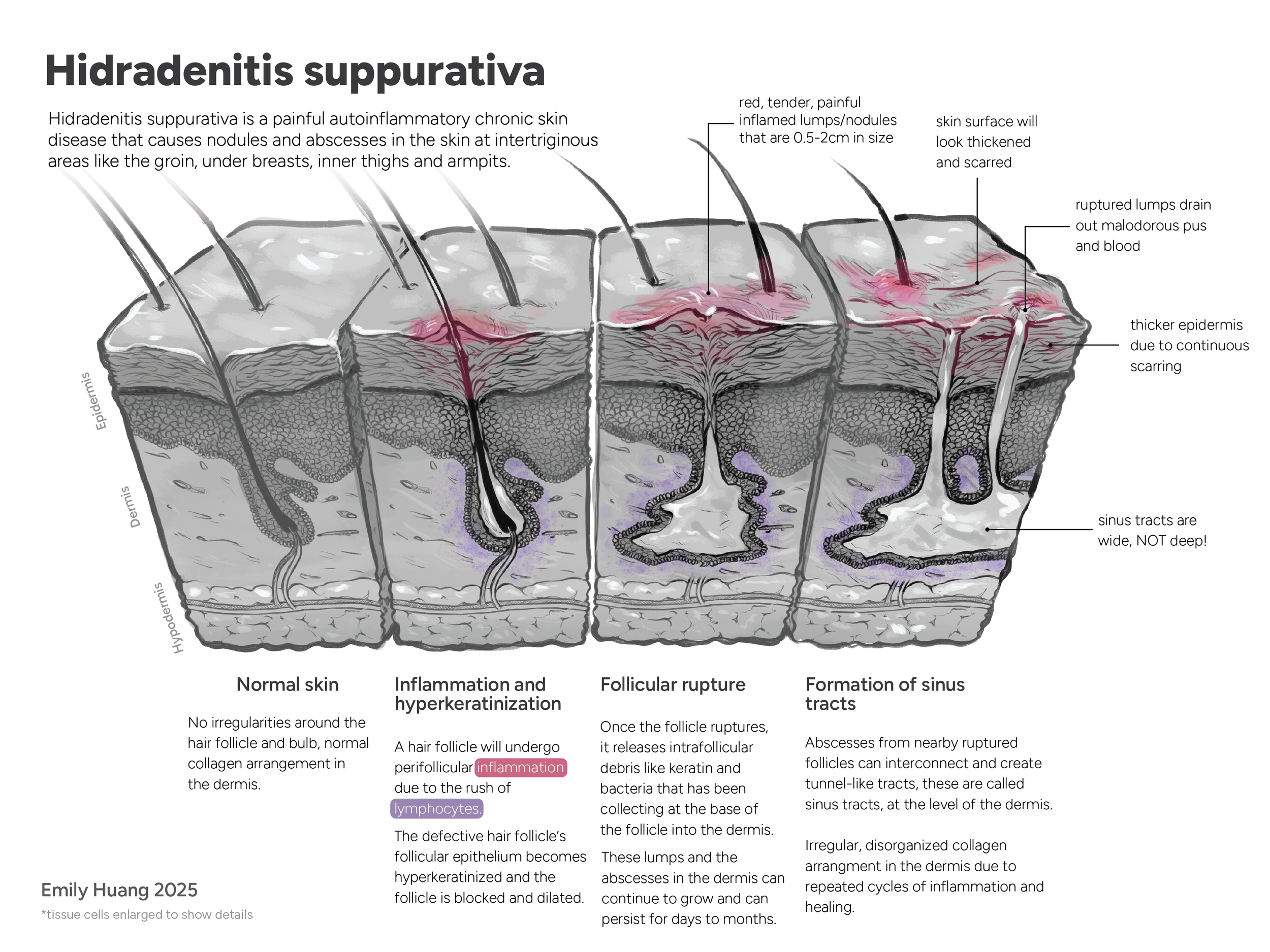 Pathological IllustrationHidradenitis Suppurativa Emily Huang