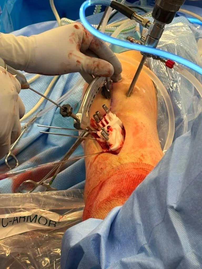 Newman Osteotomy