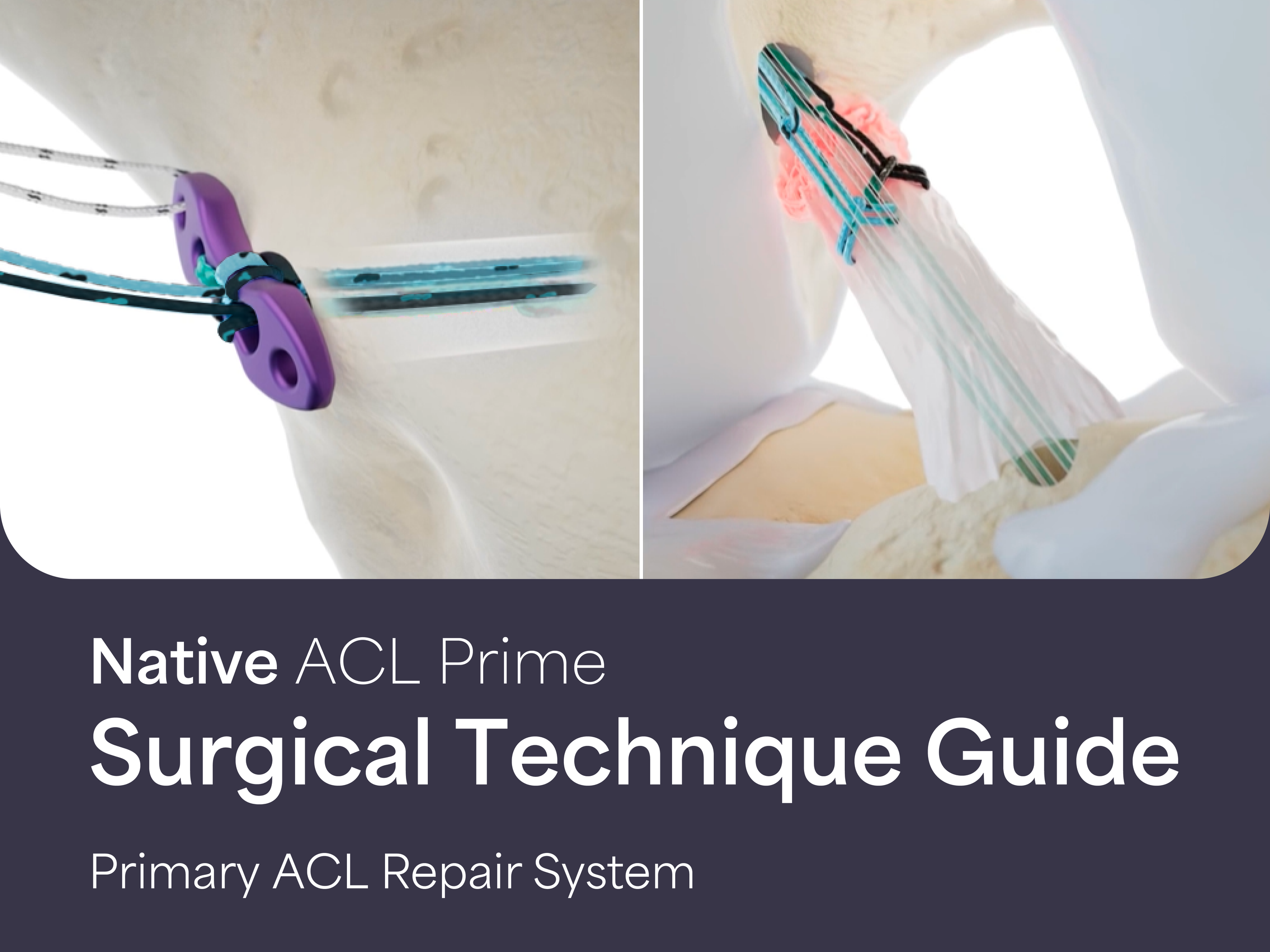 Native ACL Prime: Surgical Technique Guide