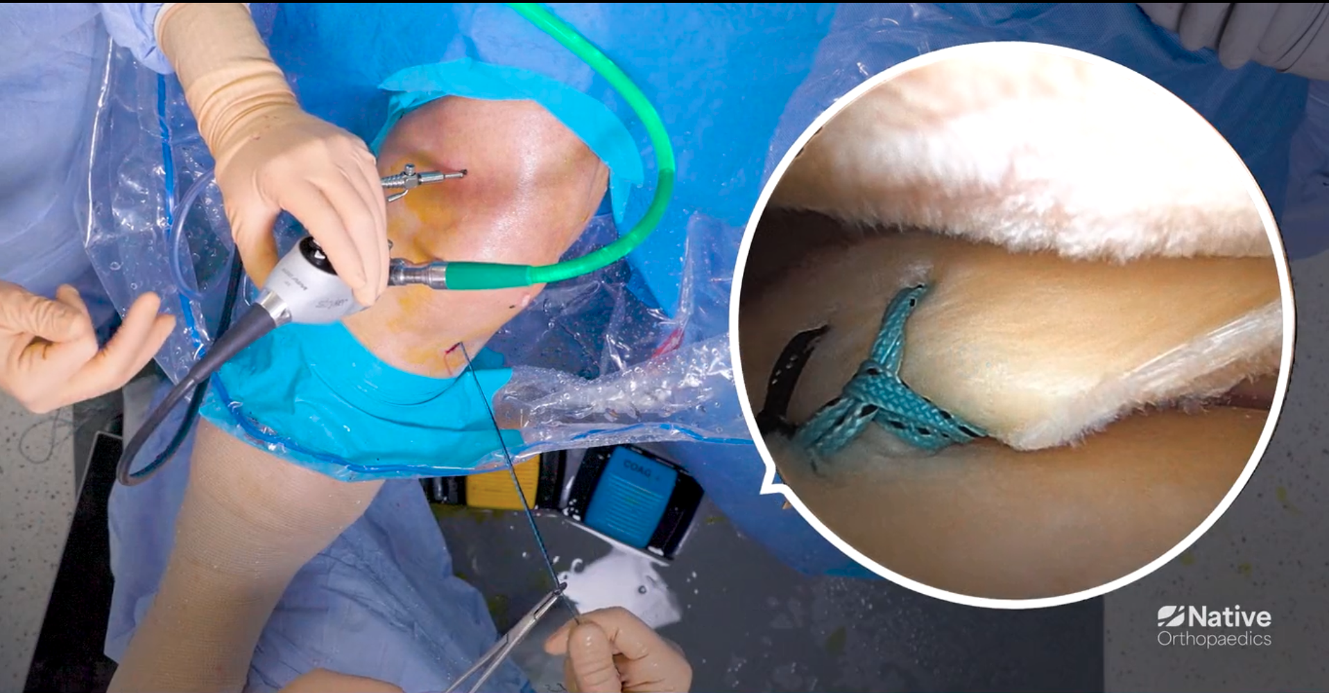 Native Root Step 8: Preliminary Fixation