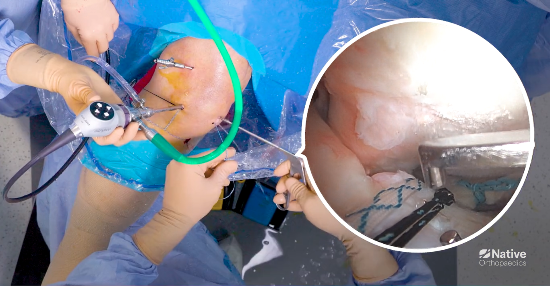 Native Root Step 6: Shuttle down the Tibial Tunnel