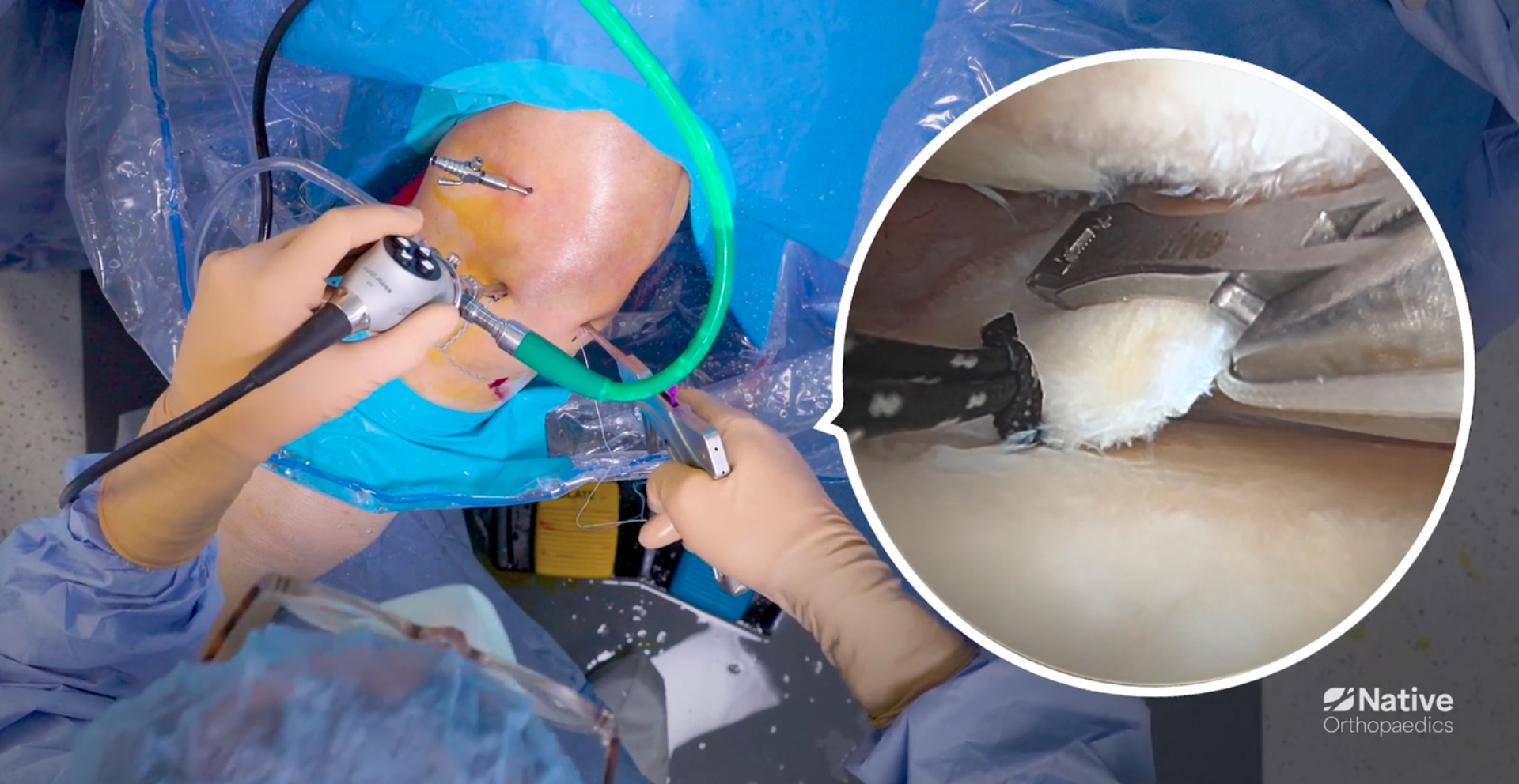 Native Root Step 5: Secure the second suture